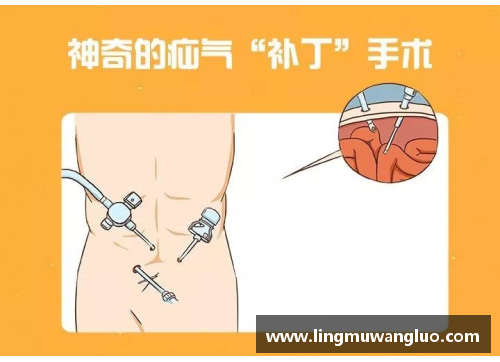 vr彩票官网腹股沟疝球员的治疗与预防措施 - 副本